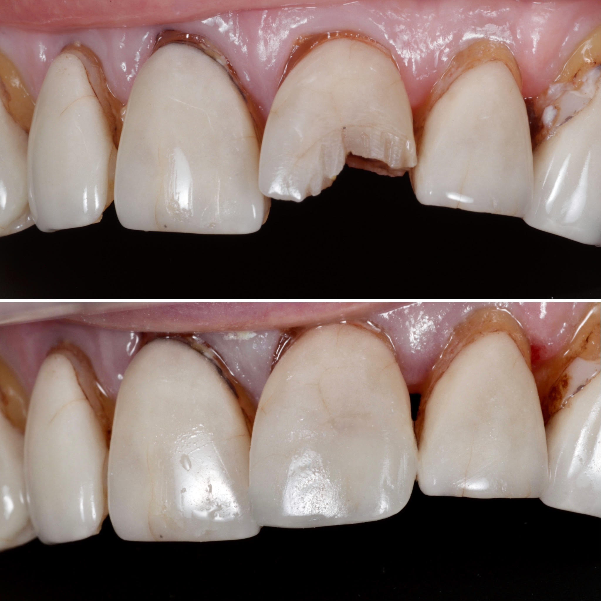 Repairing Teeth with Composite Resin